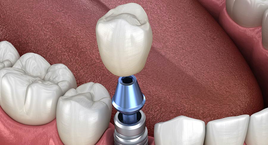 dental implant