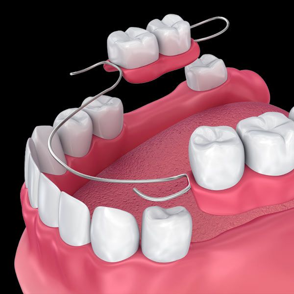 Partial Dentures