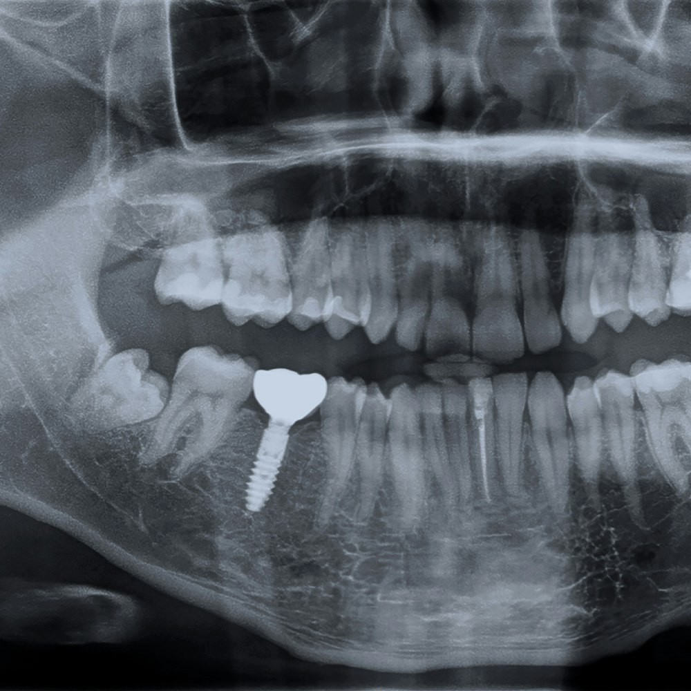 dental implant in jaw xray