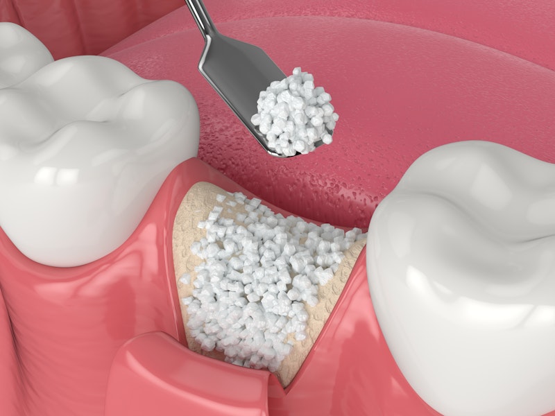 3D illustration of bone grafting