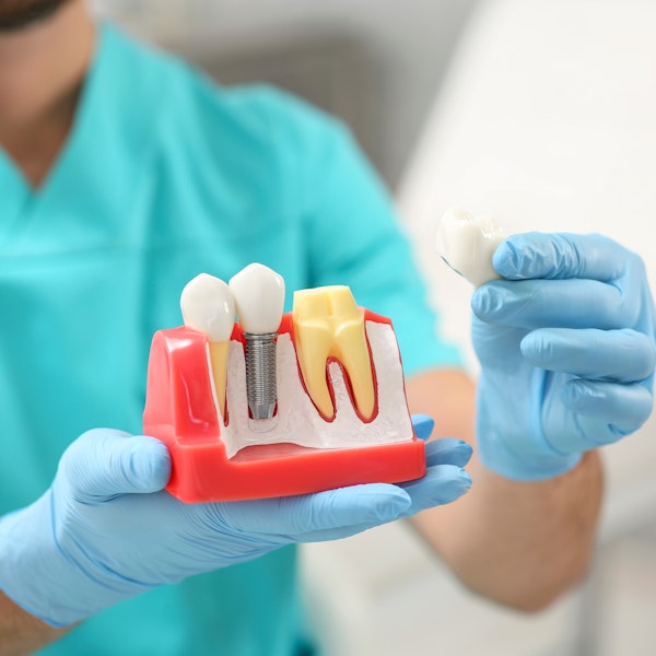 dentist holding model of implant-supported and traditional dental crown.