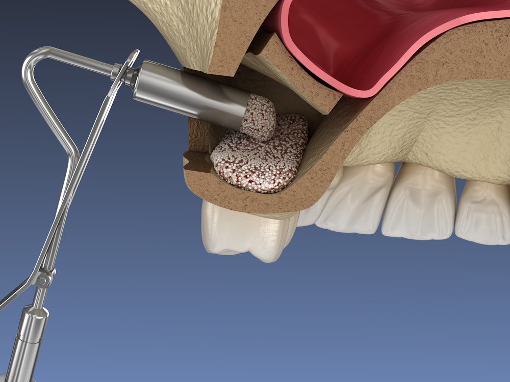 Illustration of a sinus lift with bone graft