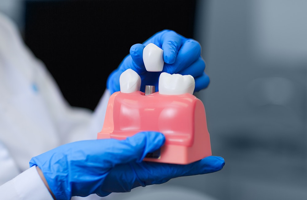 Dental Crown