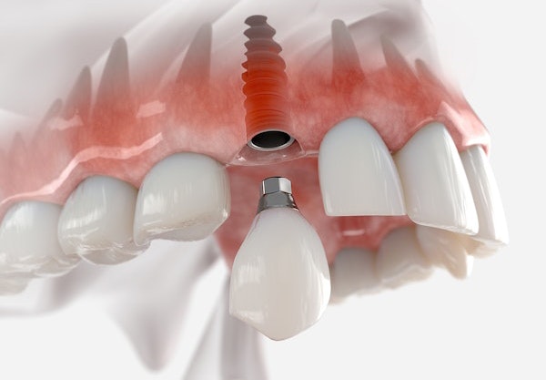 Dental implant