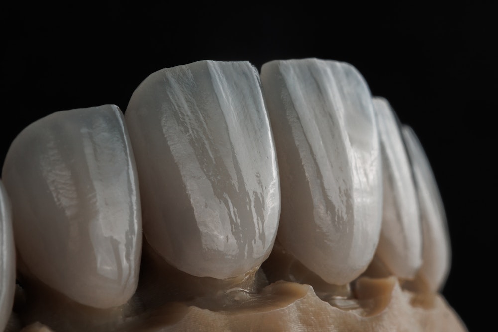 veneers on a model dental arch