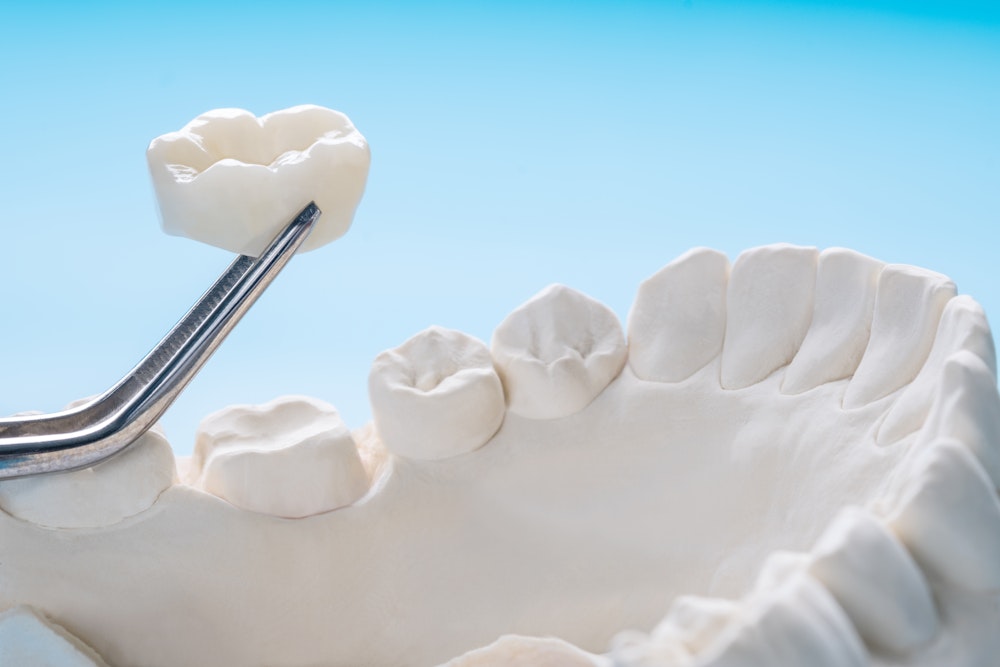 dental crown