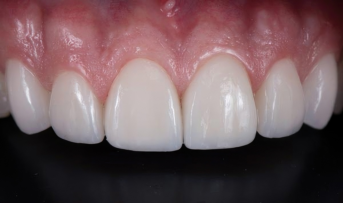 after veneers