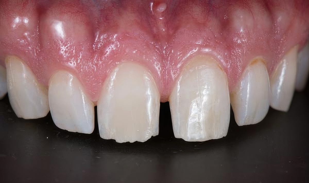 before veneers