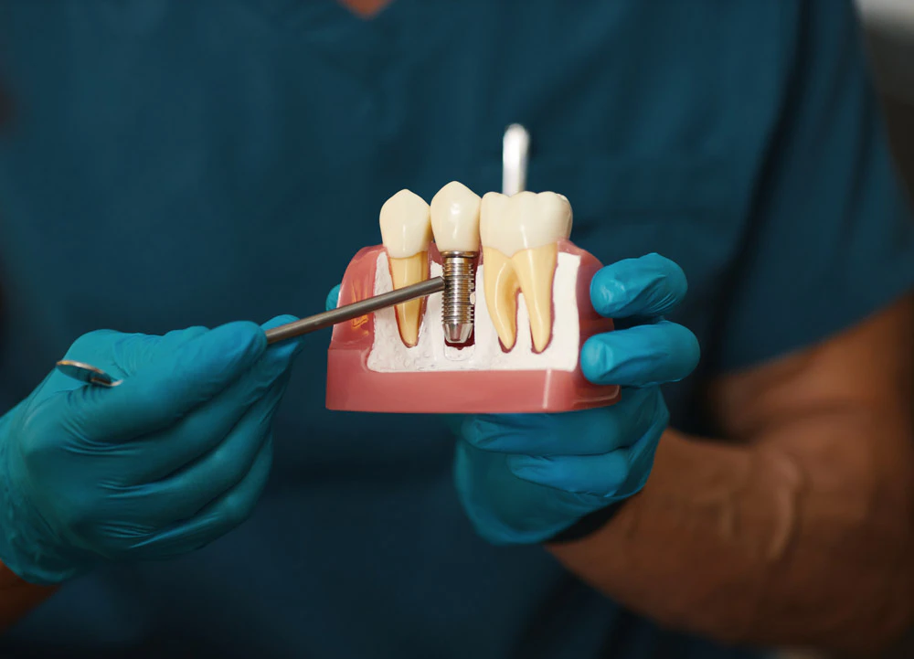 plastic model showing implant-supported crown