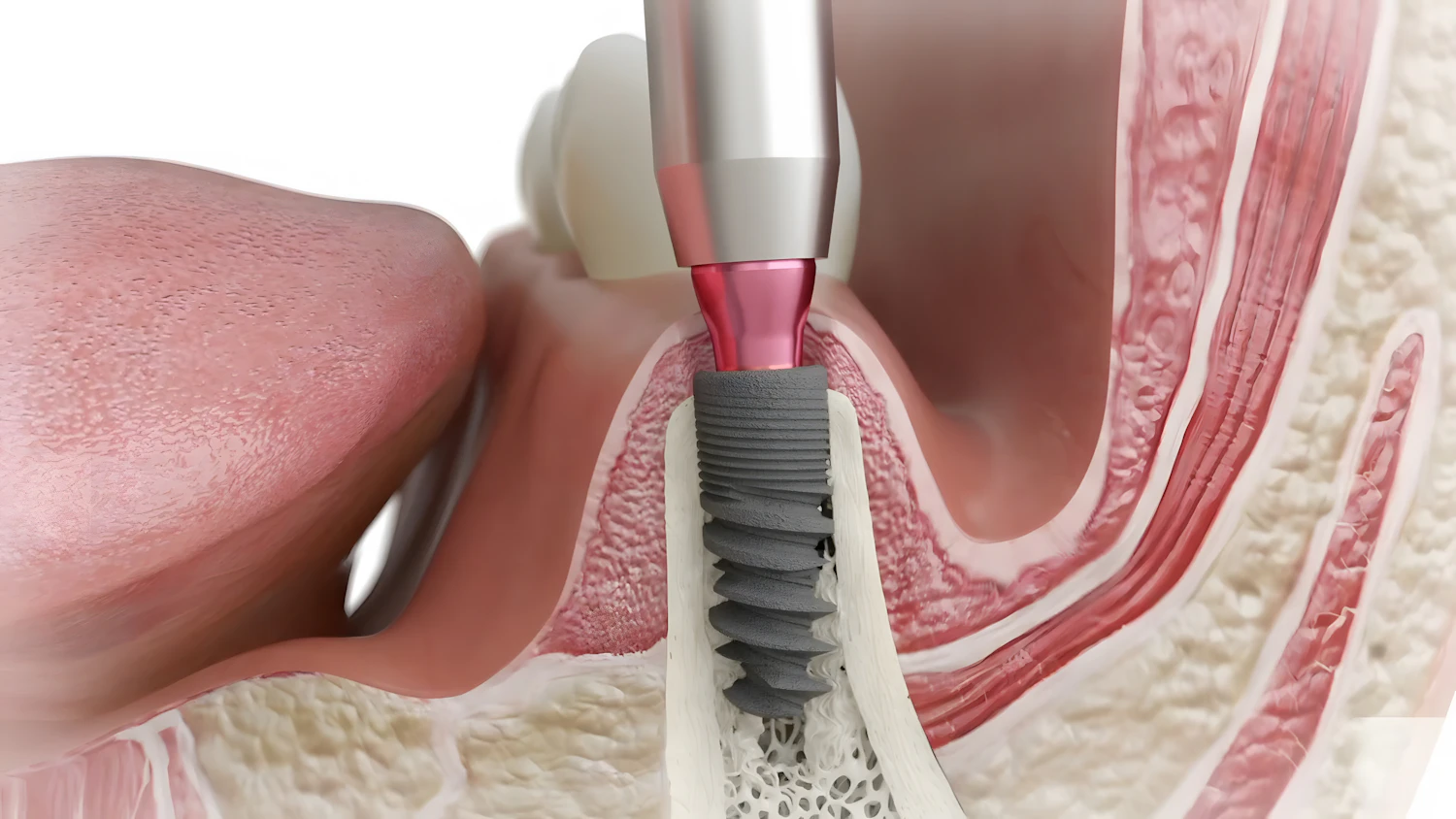 dental implant