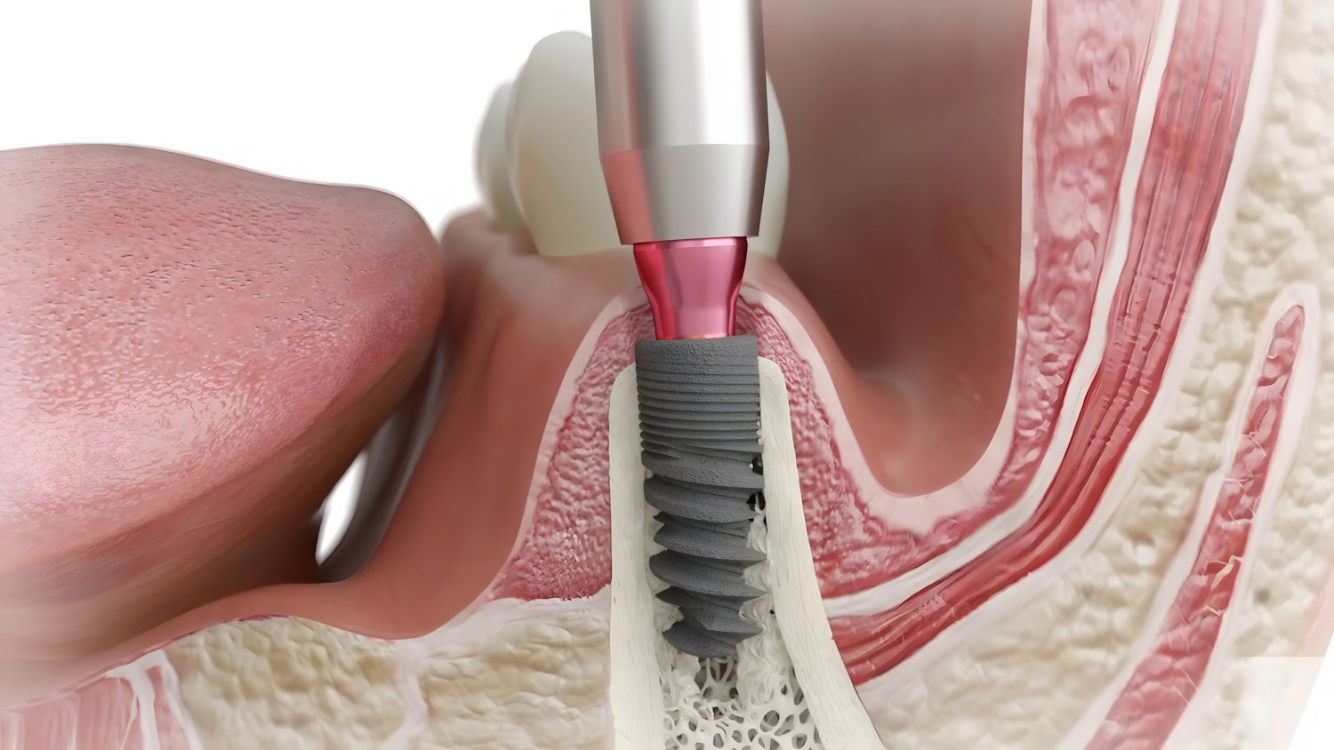 dental implant