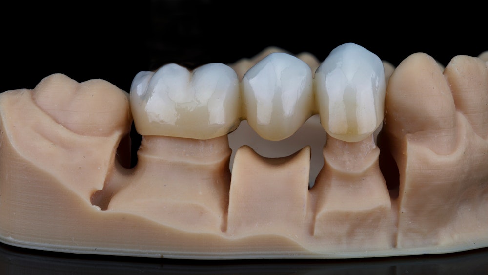 dental bridge