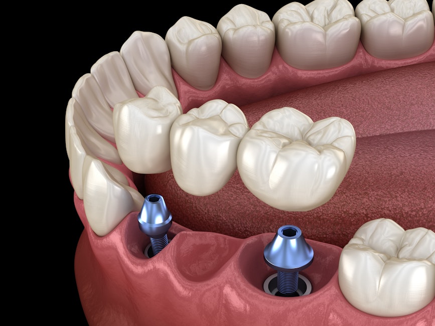 implant-supported bridge
