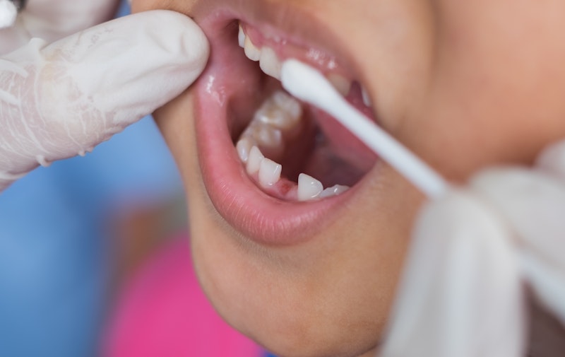 applying fluoride to child's teeth