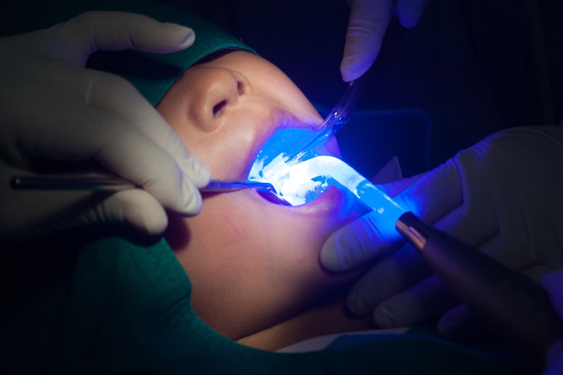 applying dental sealant