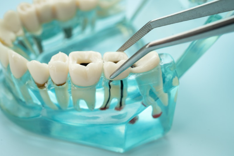 extracting a model tooth