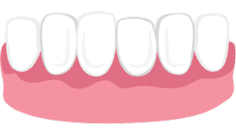 illustration of tooth wear