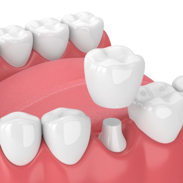 Dental crown diagram
