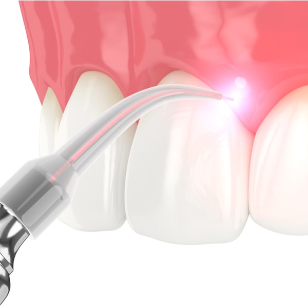 Illustration of gums being contoured with a laser