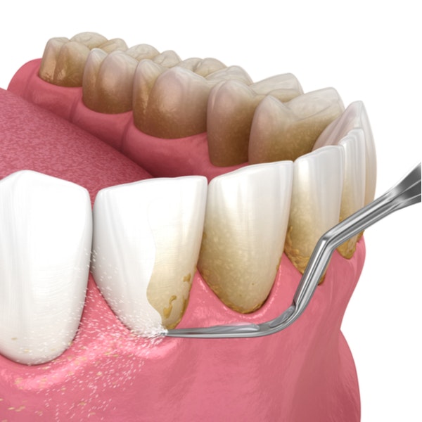 Illustration of teeth being scaled and cleaned with a water pick