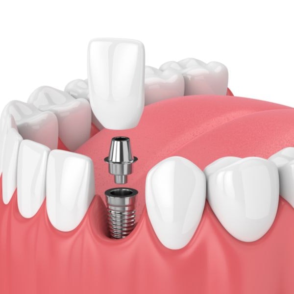 Illustration of the components of a dental implant and how they are placed in the mouth