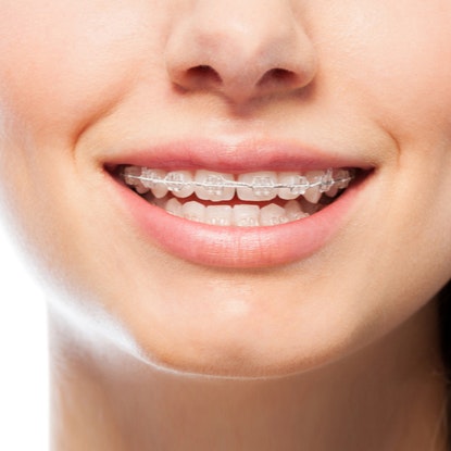 Woman wearing ceramic braces