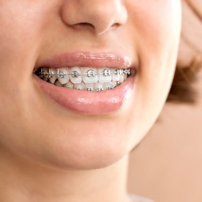 Woman wearing metal braces