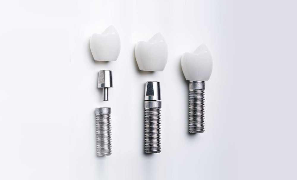Dental implants showcasing the different parts