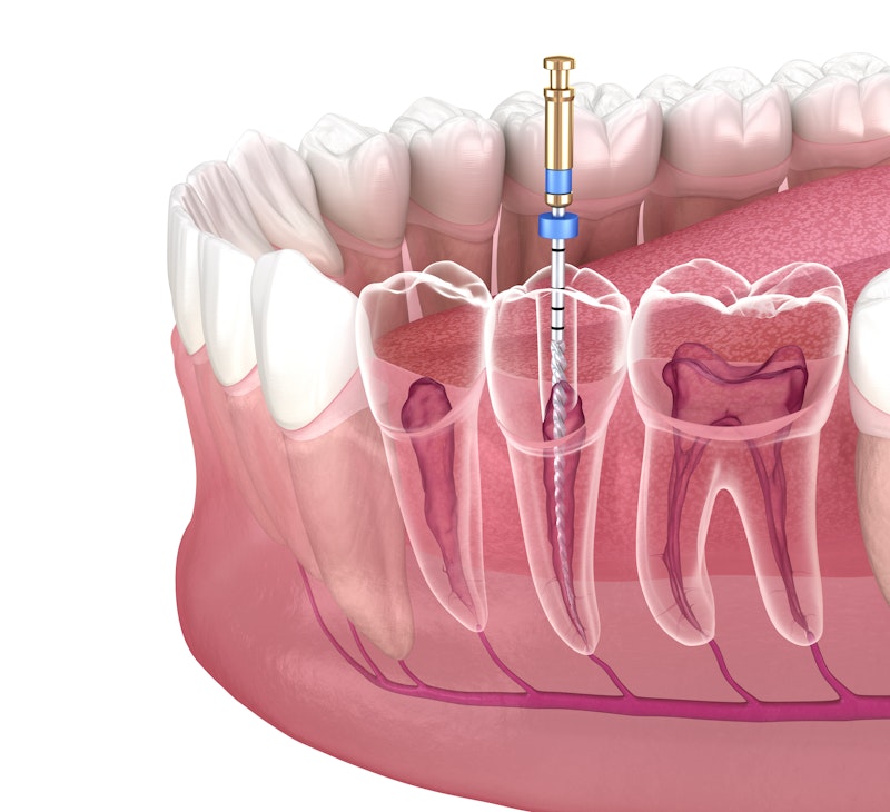 root canal diagram