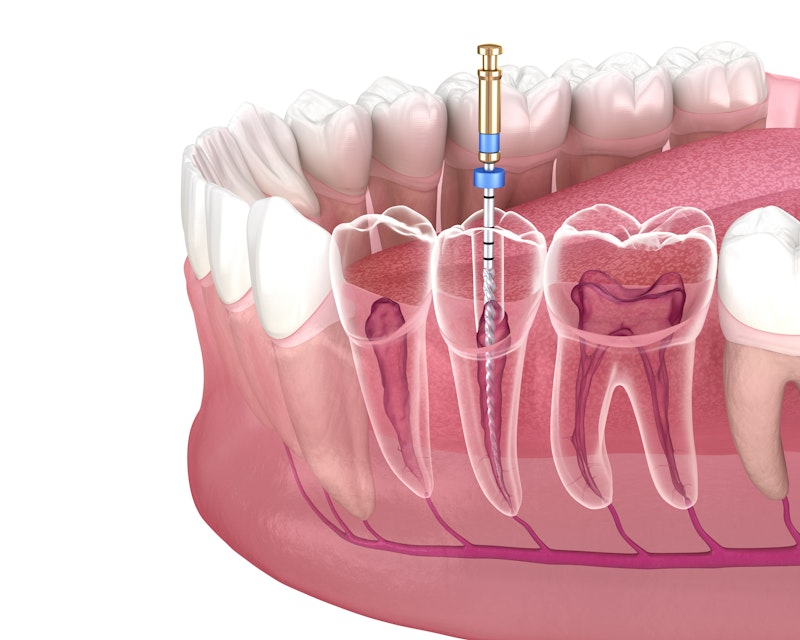 root canal diagram