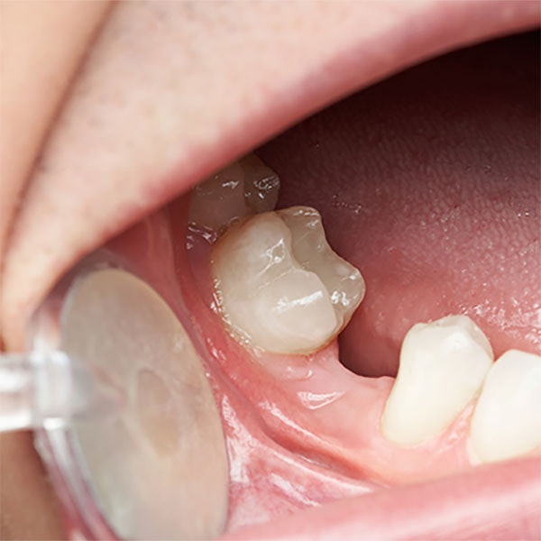 space between teeth after extraction