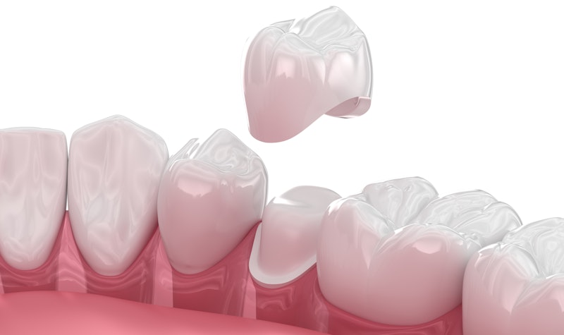 a dental crown being placed on a treated tooth