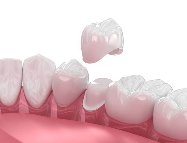 a dental crown being placed on a treated tooth