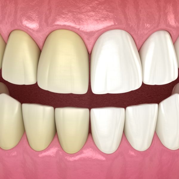 Teeth before and after whitening