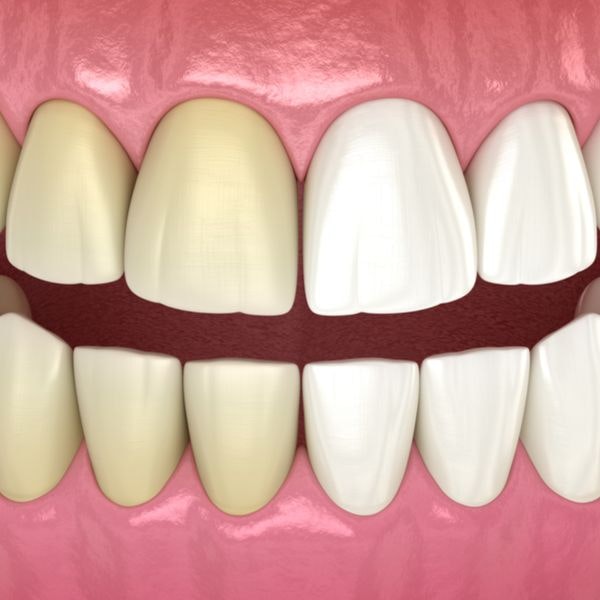 Teeth before and after whitening