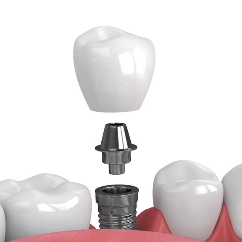 Dental Implants