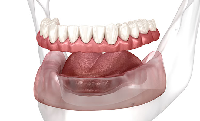 Illustration of a traditional denture