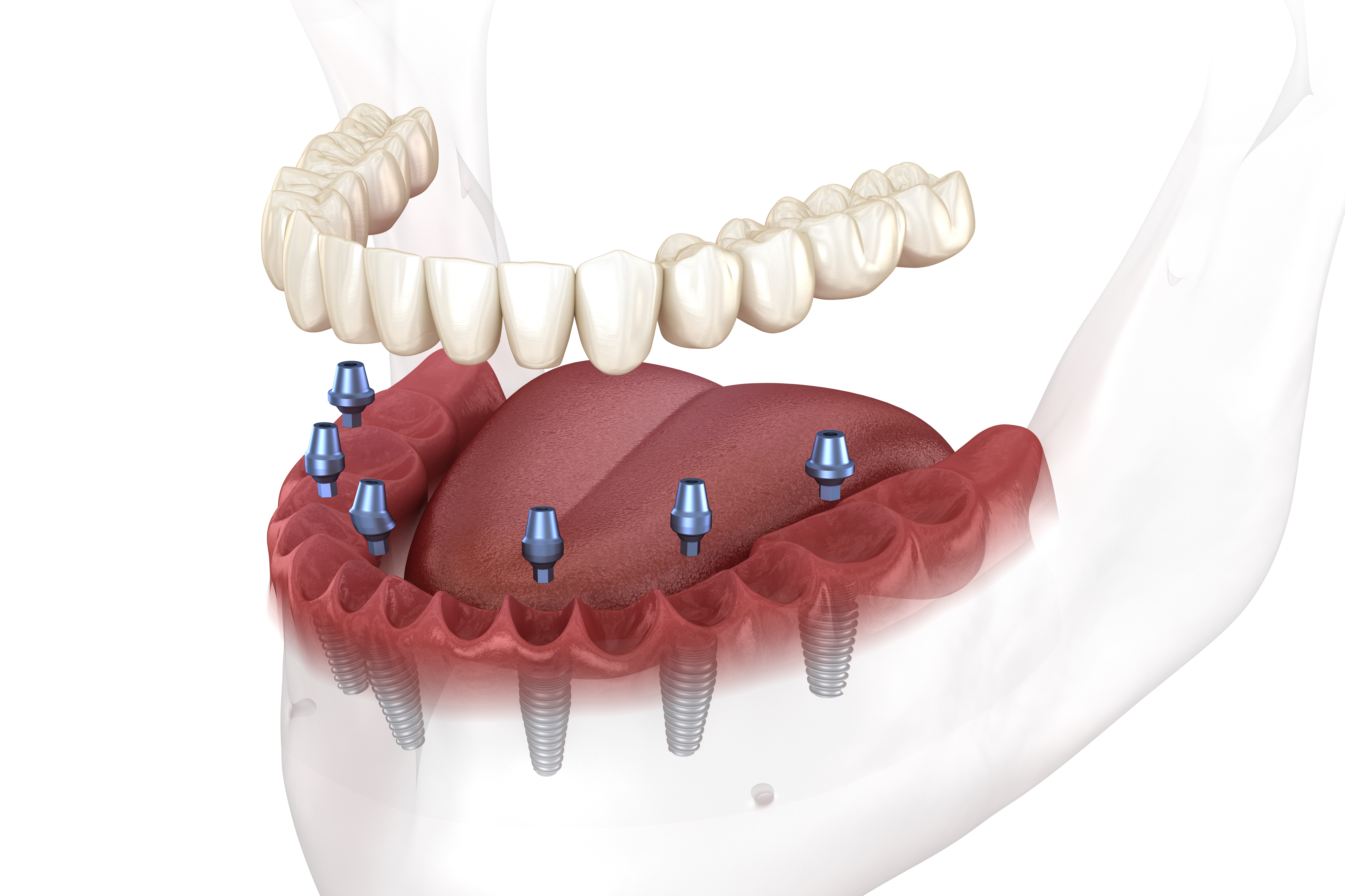 Illustration of implant-supported dentures