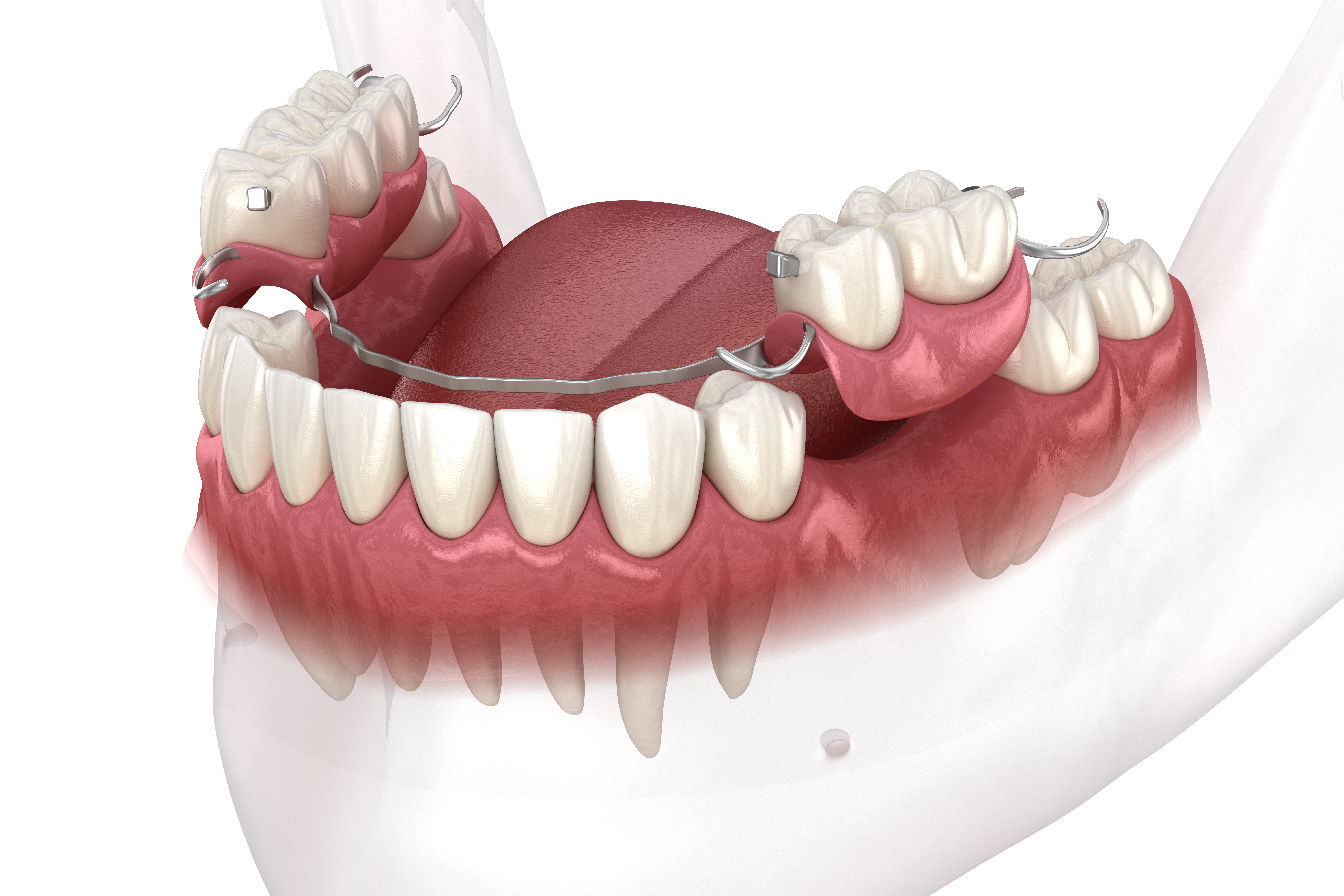 Illustration of partial dentures