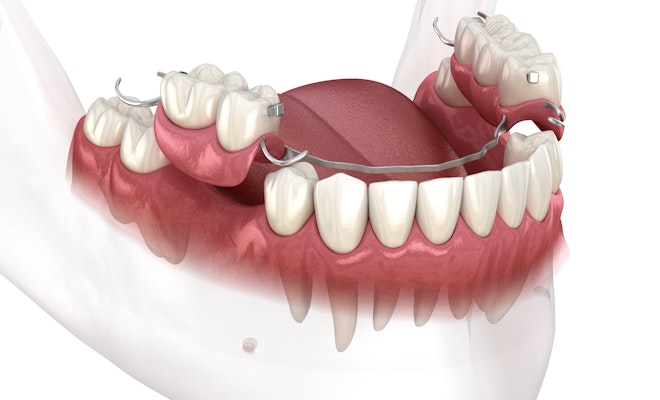 Illustration of partial dentures
