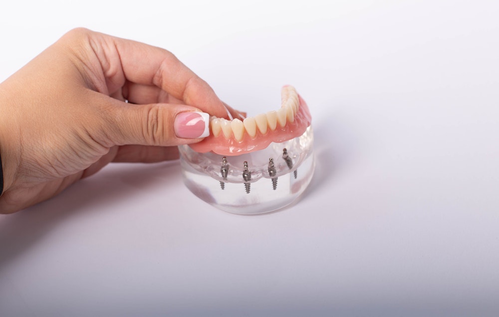 Hand placing implant dentures on a model
