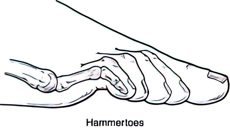 Hammertoe diagram.