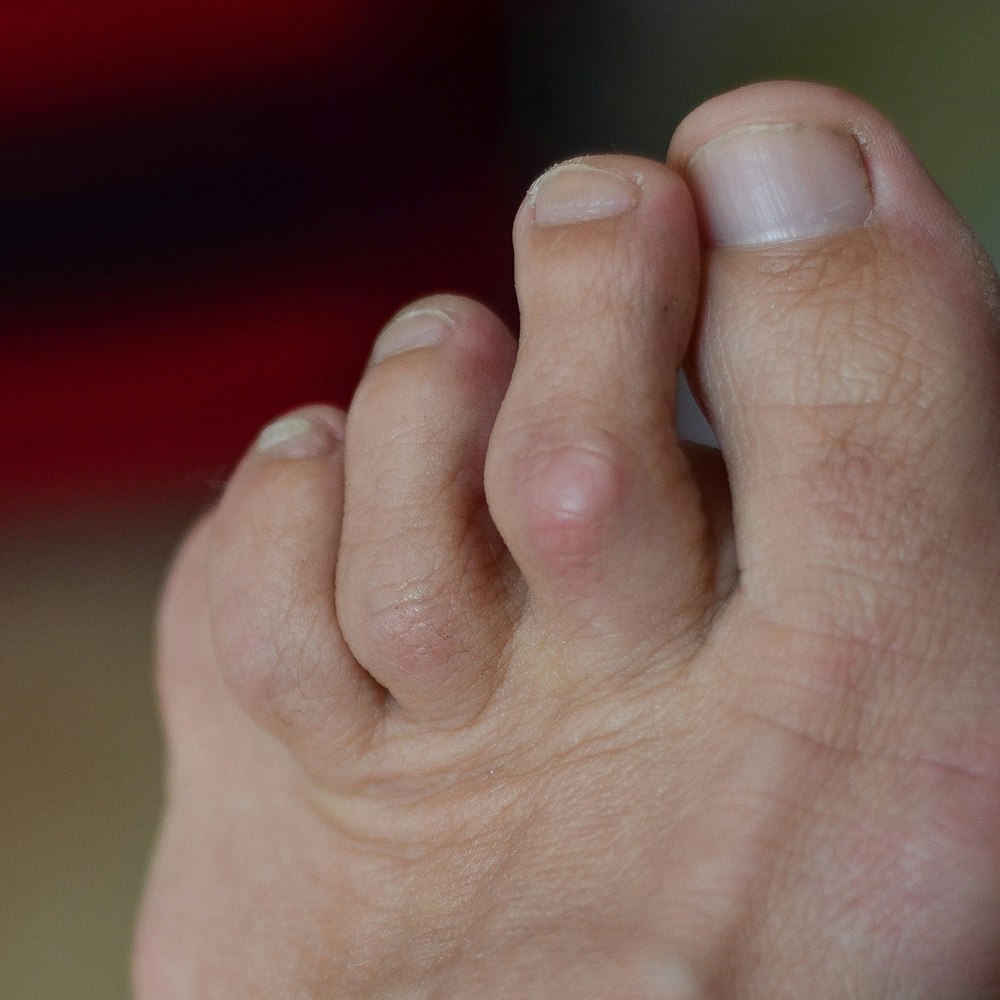 Foot with Hammertoe