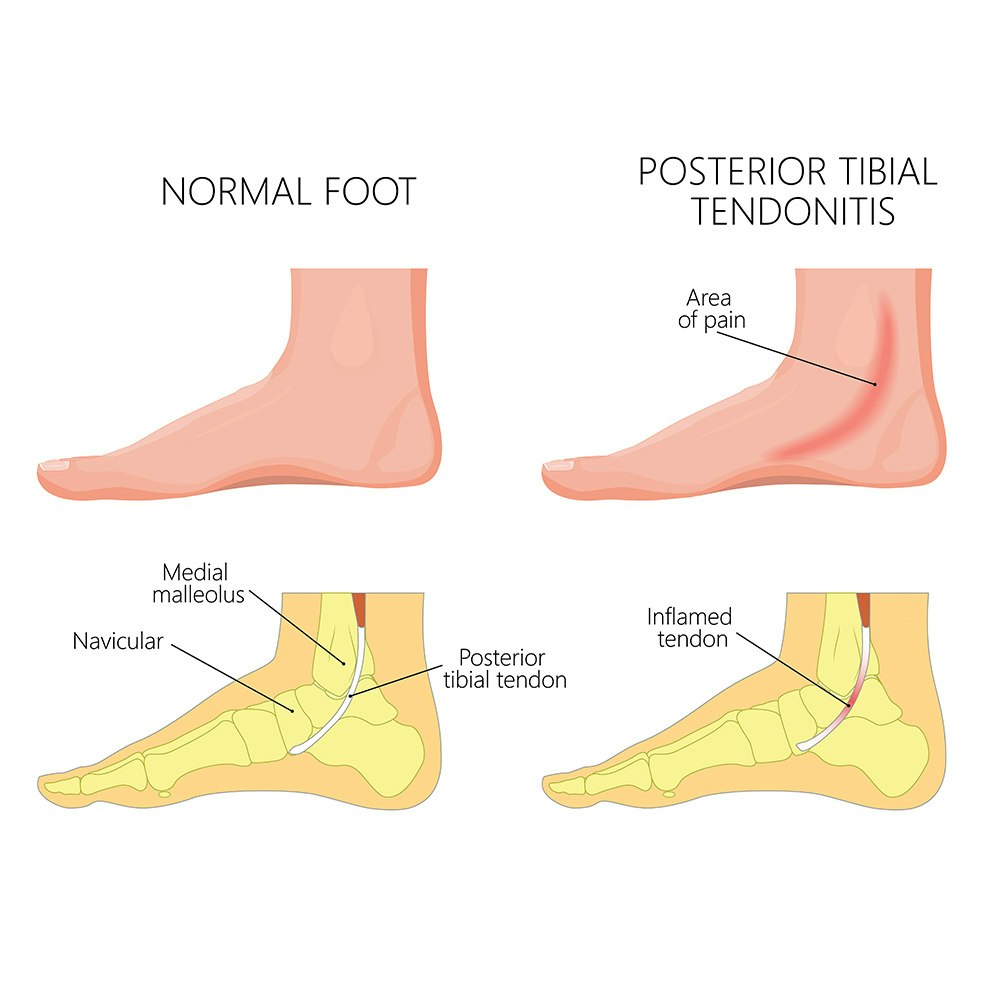 Posterior Tibial Tendonitis