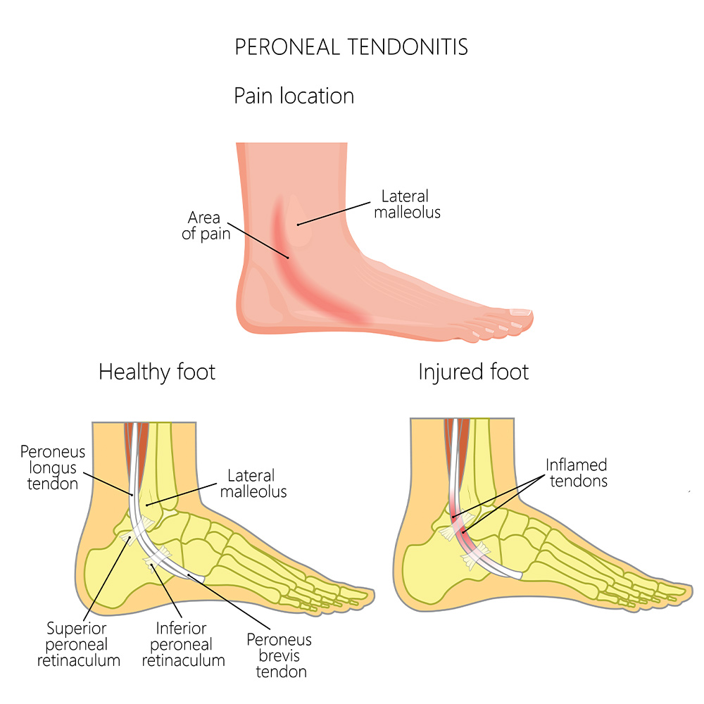 Peroneal Tendonitis
