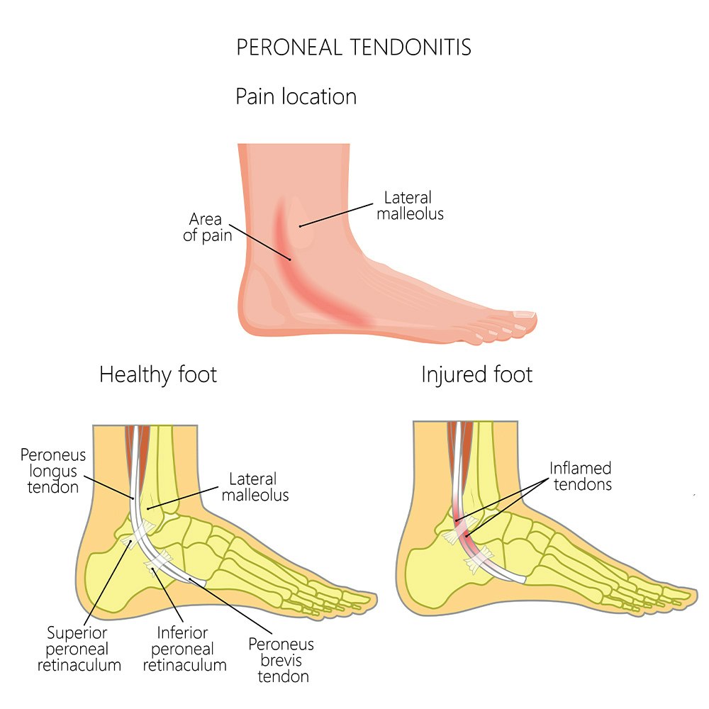Peroneal Tendonitis