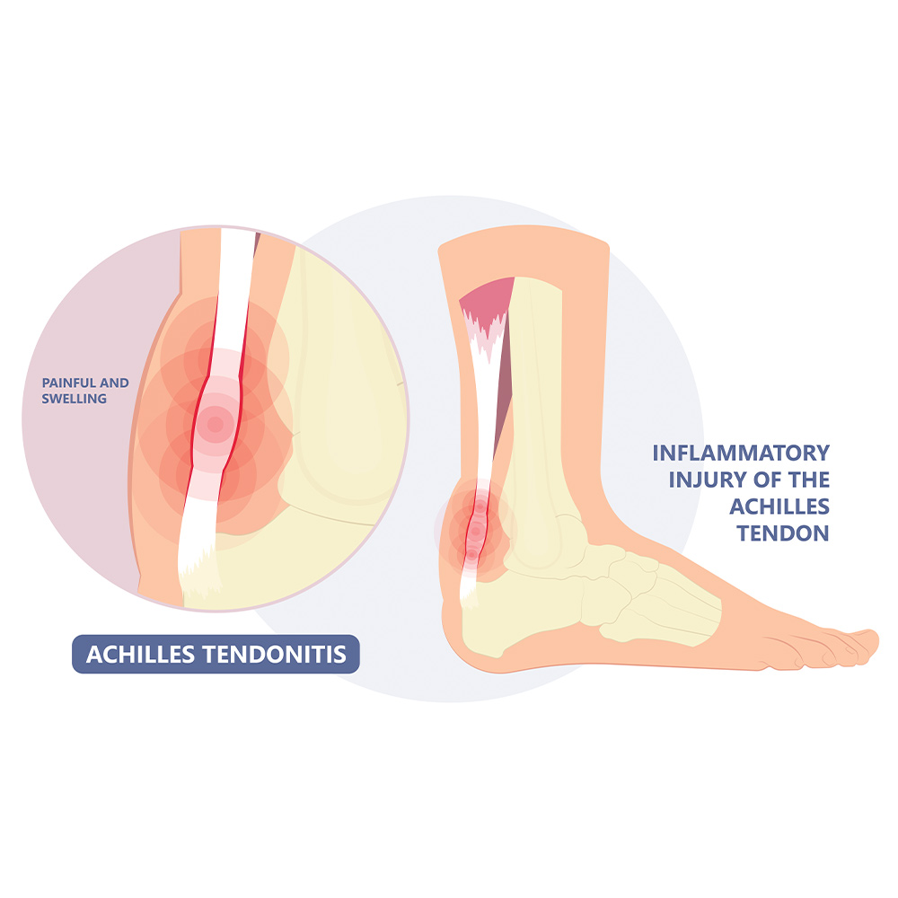 Achilles Tendonitis
