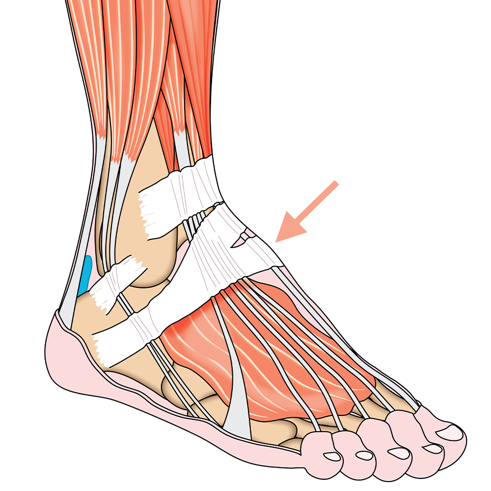 Extensor Tendonitis