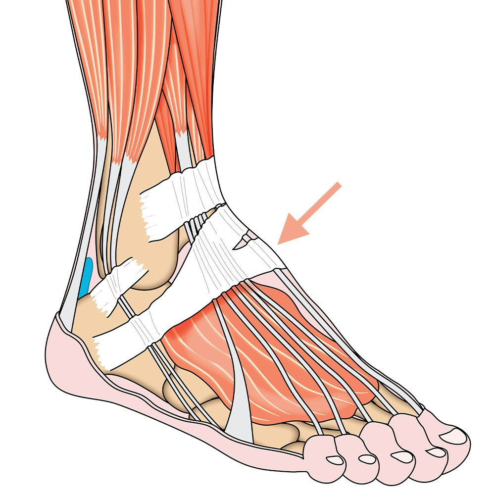 Extensor Tendonitis