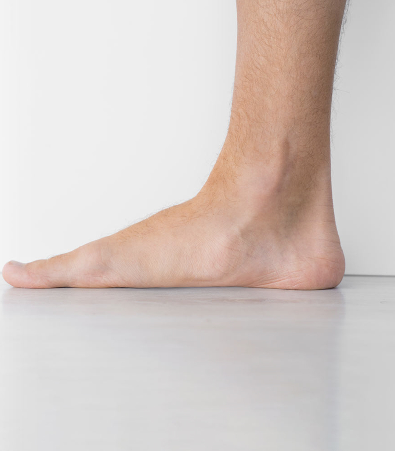 Flat foot
